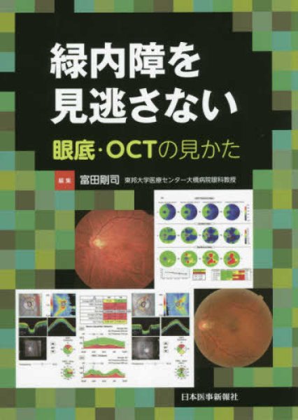 画像1: 緑内障を見逃さない 眼底・OCTの見かた (1)